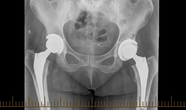 Hip Replacement